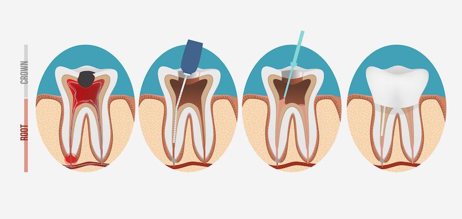 root canal treatment in pitampura