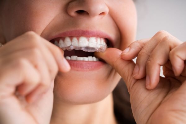 Best Dentist in Delhi - Invisible aligners