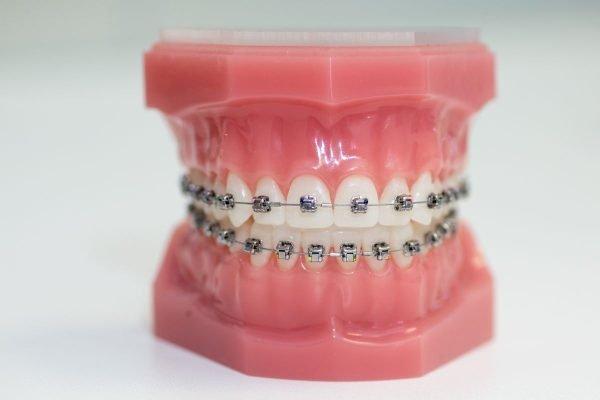 ORTHODONTIC Braces