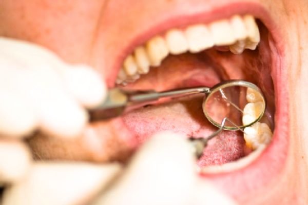 Painless Root Canal
