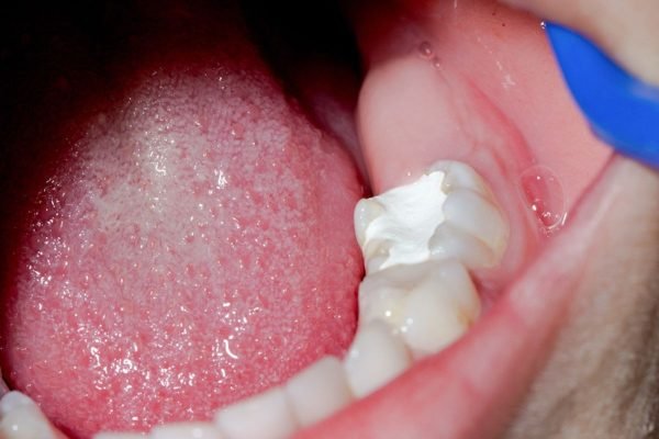 Teeth Filling