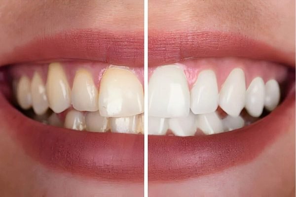 Best Dentist in Delhi